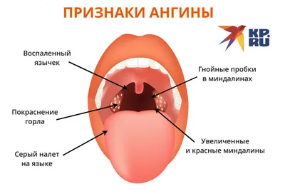 Ангина у взрослых: симптомы, лечение, профилактика в домашних условиях