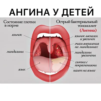 Гнойная ангина, чем лечить гнойную ангину, симптомы и признаки - блог  Furasol®