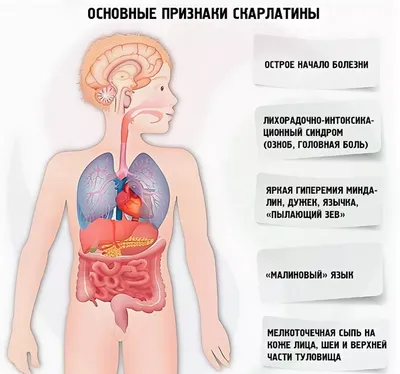 Ангина: причины, симптомы и лечение в статье инфекциониста Александров П. А.