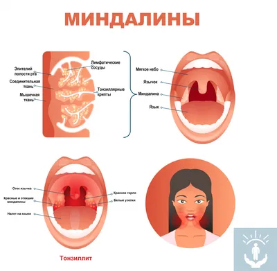 Ангина