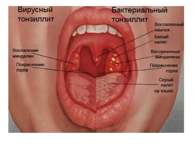 Антибиотики при ангине: какой антибиотик лучше при ангине или тонзиллите |  Doc.ua
