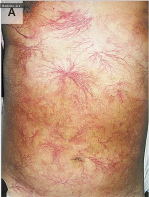 С 4 по 10 сентября – Неделя профилактики кожных заболеваний