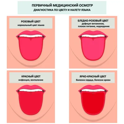 Красные пятна на языке : виды, причины, симптомы и лечение гололосита