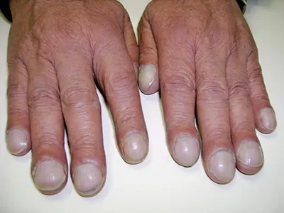 Лечение «Ковидных ногтей» в Москве в отделении дерматовенерологии клиники  ИАКИ