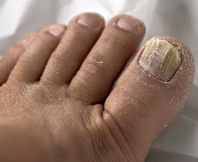 Онихолизис ногтей – симптомы, причины, виды, способы лечения и профилактики  болезни