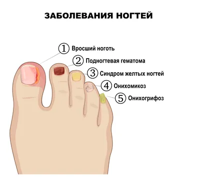 Грибок ногтей на ногах - симптомы, первые признаки, причины, как определить  болезнь