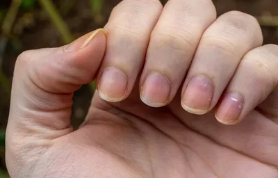 Заболевания ногтевой пластины» онлайн курс | Ксения Чумак - YouTube