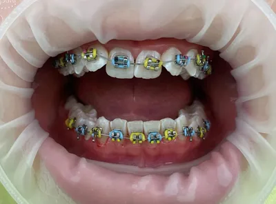 Исправление неправильного прикуса зубов — поставить брекеты на зубы, цены в  стоматологии Эстетик Арт, Екатеринбург