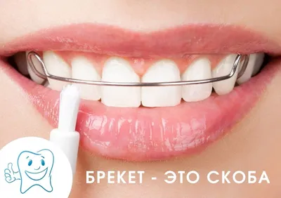 Брекеты на зубы Шымкент цена | Стоимость установки брекетов