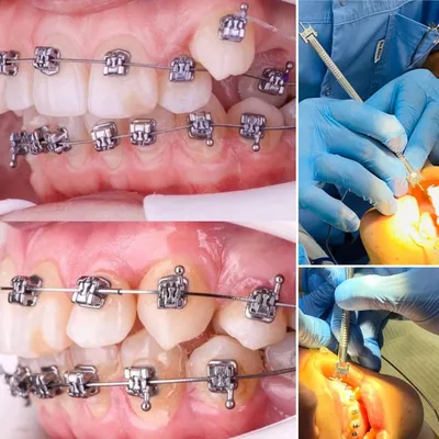 Лингвальные брекеты (внутренние): цены, сроки и установка невидимых брекет-систем  в Краснодаре | Стоматологическая клиника «Евродент люкс»