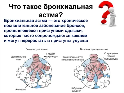 Лечение бронхиальной астмы в Екатеринбурге - Новая больница