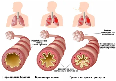 Бронхиальная астма - признаки, симптомы, диагностика