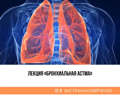 Бронхиальная астма - что это такое, причины развития, классификация,  симптомы, диагностика, лечение, профилактика
