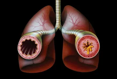 Бронхиальная астма у детей: оказание помощи при приступе БА