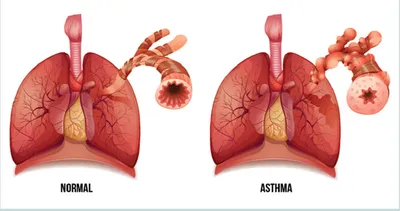 Книга Бронхиальная астма и инфекции - купить здравоохранения, медицины в  интернет-магазинах, цены на Мегамаркет | 7082