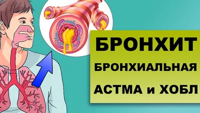 Бронхиальная астма у детей: полное описание, симптомы и причины