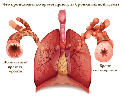 Как понять, что у тебя бронхиальная астма, к какому врачу обратиться