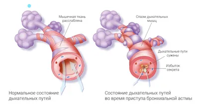 Как и когда аллерголог ставит диагноз «бронхиальная астма»? | Аллергология  и Иммунология