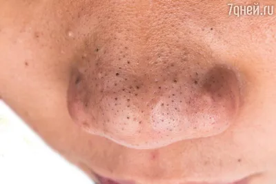Черные точки на носу: причины появления и как их убрать в домашних условиях  | 7Дней.ru | Дзен