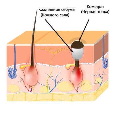 Чёрные точки – комедоны: эффективное лечение - Клиника \"Отражение\"
