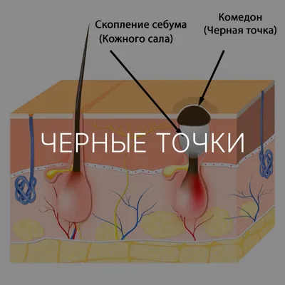 Комедоны (чёрные точки) - причины, симптомы, лечение, диагностика, патогинез