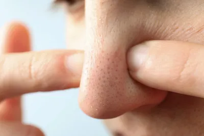 Черные точки на лице: причины появления комедонов, симптомы и лечение акне,  процедура чистки кожи