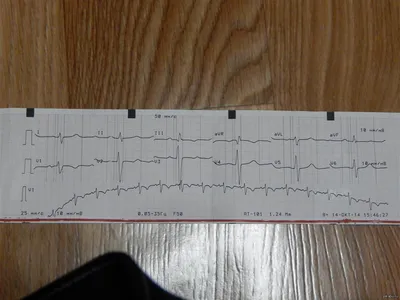 Расшифровка ЭКГ | Пикабу