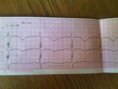 Ребята,помогите! Нужна расшифровка ЭКГ по фото | Пикабу