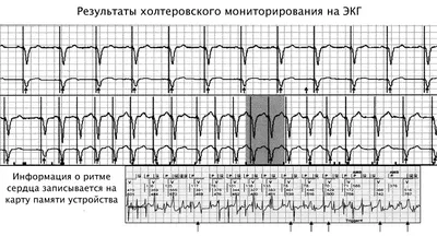 Анализ ЭКГ искусственным интеллектом: расшифровка данных и диагностика  нейронными сетями