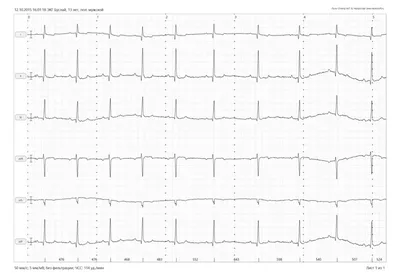 АВ блокада I степени - E-Cardio