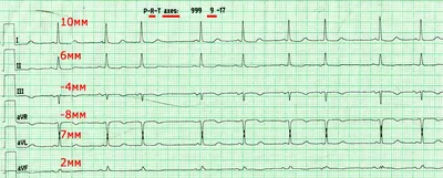 Электрокардиограммы. Разбор ЭКГ с ответами и расшифровкой : Кардиология -  Farmf | литература для фармацевтов