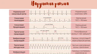 Норма и патология на ЭКГ: Нарушения Ритма - YouTube