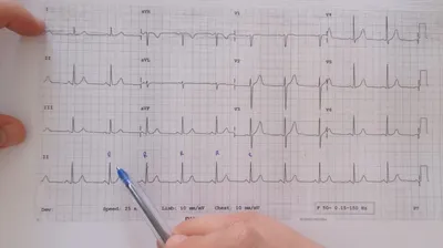 ЭКГ-признаки ишемии миокарда