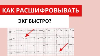 Абсолютно новая Шпора по ЭКГ | Медфорс