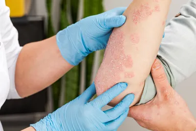 Кожные Заболевания — стоковые фотографии и другие картинки Аллергия -  Аллергия, Бактерия, Болезни кожи - iStock