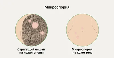 Пиодермия у взрослых: лечение, рекомендации, симптомы