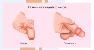 Лечение фимоза без операции у взрослых и детей в Москве - цены в клинике  АльтраВита