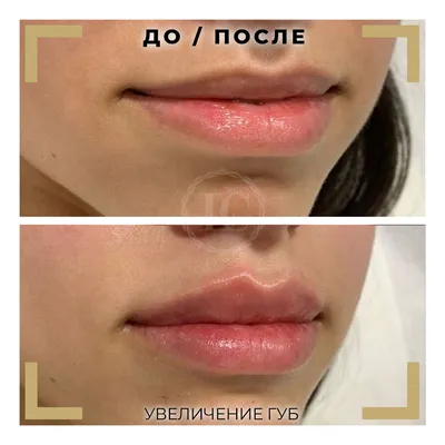 ПРОФИЛАБ МОСКВА/СОЧИ on Instagram: \"Идеальная форма губ- она какая ?  Нравится ли вам естественная форма или хочется чего-то нового ,как например  «губы осьминог… | Lips inspiration, Botox lips, Lip fillers juvederm