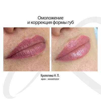 Увеличение губ | Цены процедуры | Telos Beauty