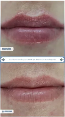 Как увеличить губы и скорректировать форму губ: способы, виды инъекций,  побочные эффекты – блог Cleo Line
