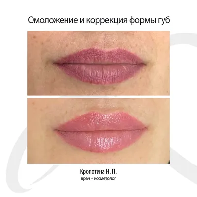 Увеличение губ гиалуроновой кислотой в Москве: цены, фото, отзывы