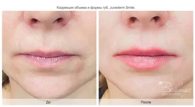 Идеальная, сексуальная форма губ сегодня особенно в моде 💯 — Доктор Карина  на TenChat.ru