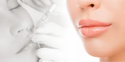Увеличение губ гиалуроновой кислотой — Damas Medical Center