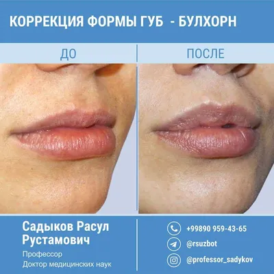 Контурная пластика губ и лица в Ижевске