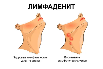 Лечение генитального герпеса у мужчин в Москве