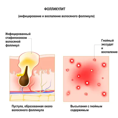 Лимфаденит: симптомы, причины, классификация, что делать при воспалении  лимфоузлов