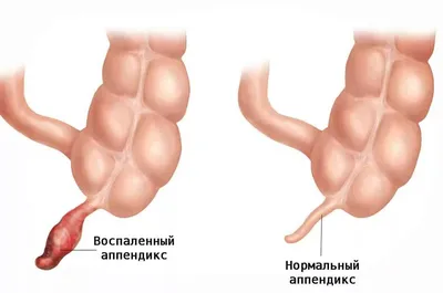 Аппендицит: симптомы у взрослых и детей | Диагностика и лечение аппендицита  в АО «Медицина»