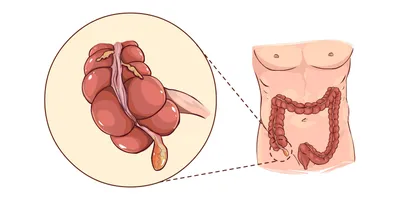 Аппендицит – симптомы, с какой стороны находится, причины и лечение