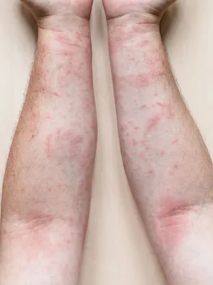 сыпь может быть вызвана вирусом сыпь на ногах может быть вызвано некоторыми  типами вирусов. Стоковое Изображение - изображение насчитывающей измерений,  опостылеть: 225352399