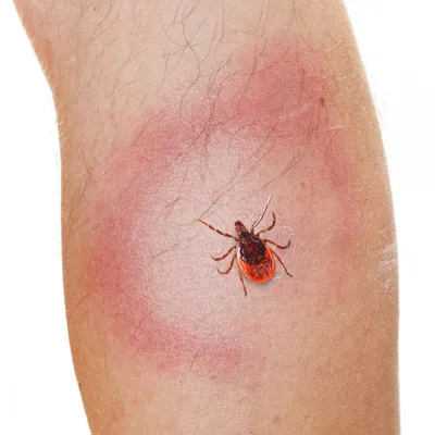 Сыпь на ногах\": европейские врачи нашли новый симптом коронавируса /  VSE42.RU - информационный сайт Кузбасса.